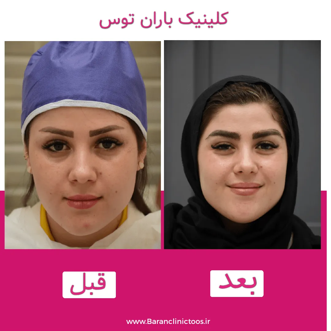 قبل و بعد کاشت ابرو